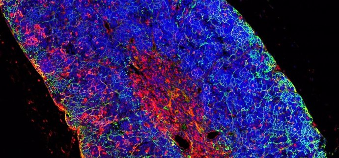 Identifican una proteína que podría conducir a mejores tratamientos en leucemia mieloide aguda