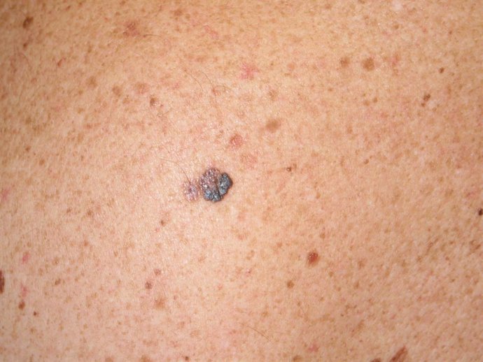 Una nueva técnica de biopsia líquida puede ayudar a determinar la progresión del melanoma