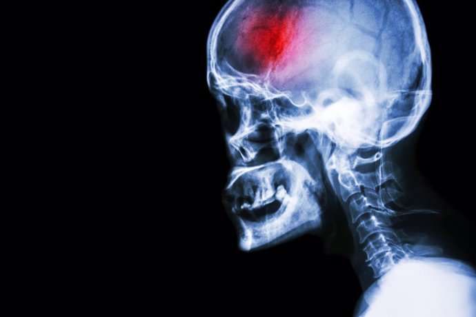 Dos fármacos para prevenir el accidente cerebrovascular y la demencia se muestran prometedores en un ensayo clínico