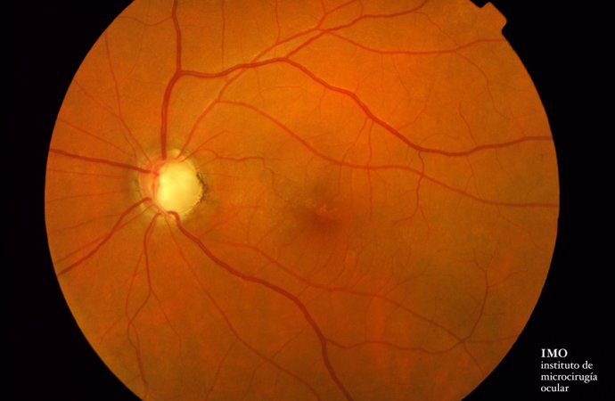 El 20% de pacientes con esclerosis múltiple descubren el primer brote de la enfermedad en el oftalmólogo