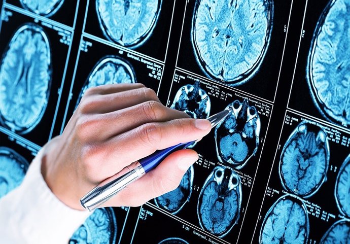 Sevilla.- Investigadores de la US logran bloquear una proteína fundamental en el desarrollo del Alzheimer
