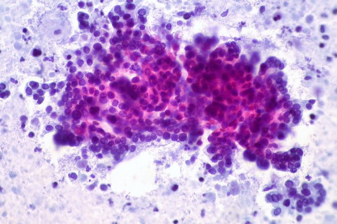 Una nueva combinación de inmunoterapia y quimioterapia reduce los tumores de cáncer de páncreas, según ensayo clínico