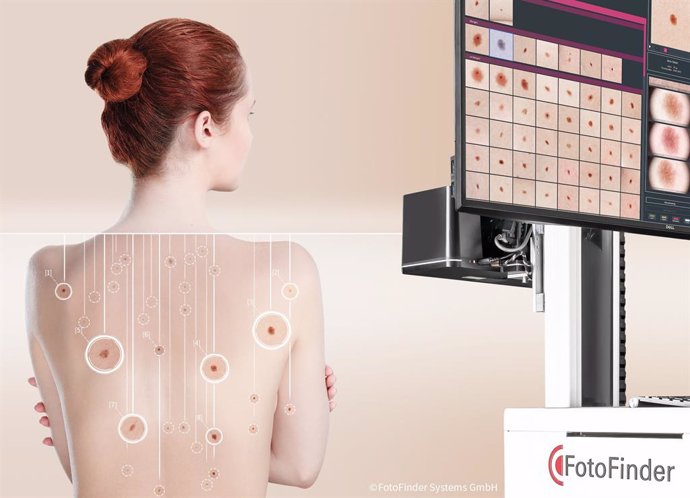COMUNICADO: FotoFinder presenta la próxima generación de técnicas para la detección precoz del cáncer de piel