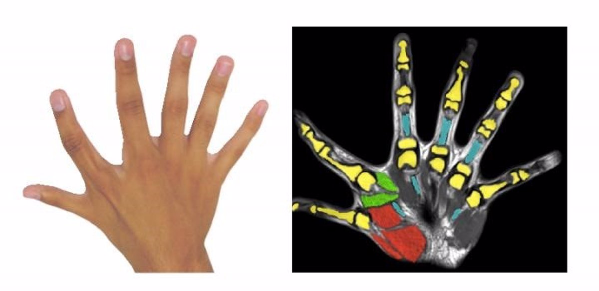 Gaseoso reaccionar ven Tener seis dedos permite realizar actividades con una mano que normalmente  requieren de las dos