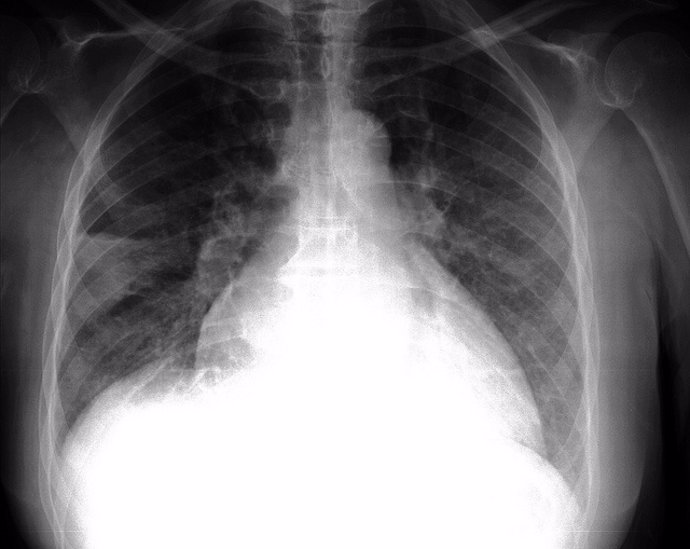 EEUU.- Investigadores diseñan una técnica para rehabilitar pulmones dañados 