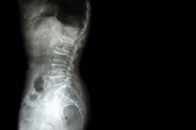 Espalda, vertebras, columna, espondilitis anquilosante