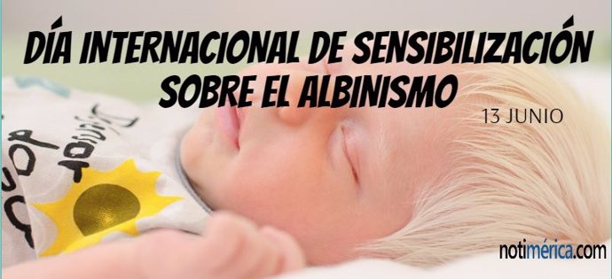 13 De Junio: Día Internacional De Sensibilización Sobre El Albinismo, ¿En Qué Consiste Esta Enfermedad?