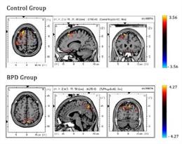 Las personas con trastorno límite de la personalidad activan regiones cerebrales distintas para controlar sus impulsos,