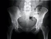 Foto: El 64% de los pacientes con displasia de cadera pueden desarrollar displasia residual por un diagnóstico tardío
