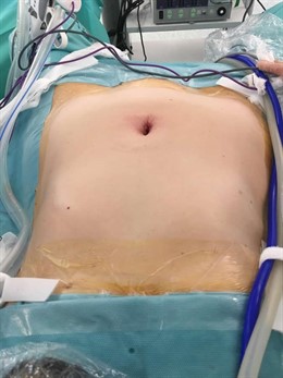 La extirpación de miomas uterinos con la cirugía de puerto único reduce en un 50% el tiempo de hospitalización
