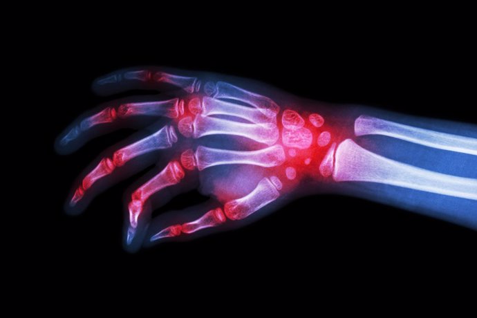 La remisión de artritis reumatoide se asocia con una reducción de las complicaciones cardiovasculares, según un estudio