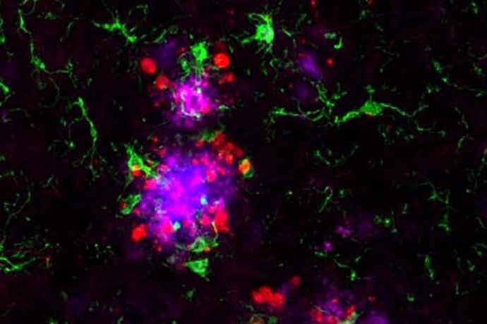 La proteína amiloide (magenta) es visible en las placas amiloides (azul) rodeadas de células inmunitarias llamadas microglia (verde) y proteína tau (roja)