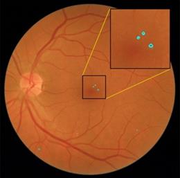 Imagen de fondo de ojo en la que el sistema ha detectado lesiones rojas, precursoras de retinopatía diabética.