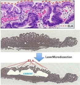 La línea de puntos rojos indica el epitelio de atipia de bajo grado (ELA) que cubre la superficie del tejido canceroso gástrico en la imagen superior. ELA (Rojo) y tejidos cancerosos (Azul) extraídos por microdisección Láser en la imagen inferior.