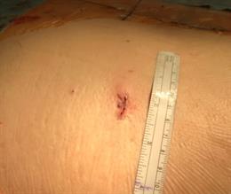 Herida de la incisión de 1,5 centímetros en una cirugía pionera de fusión de la columna lumbar percutánea