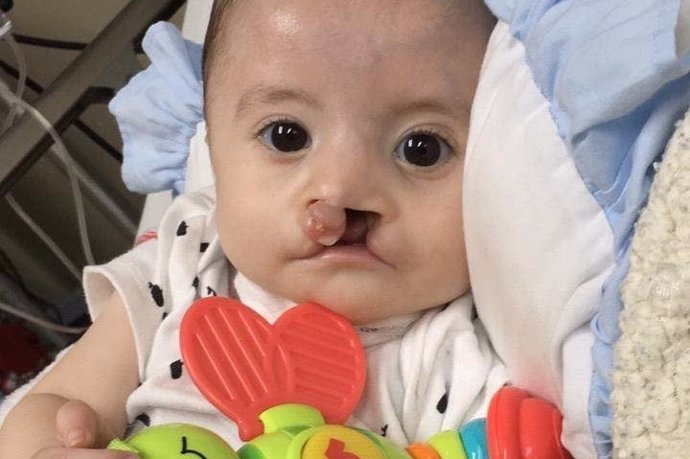Foto de Calum, un niño de nueve meses que padece síndrome de Moebius y labio leporino