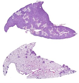 La imagen superior muestra tumores pulmonares (morados oscuros) en ratones del grupo de control en comparación con los que carecen de CRTC2 (inferior), lo que sugiere el potencial terapéutico de los fármacos que pueden interferir con CREB o CRTC2.