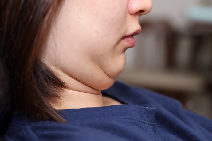Papada, obesidad, sobrepeso