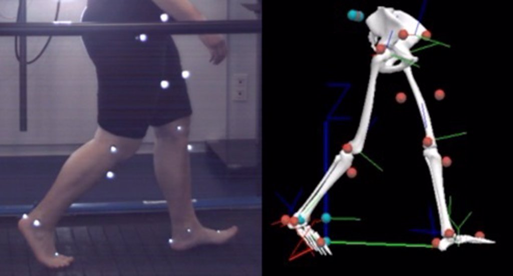 Los niÃ±os obesos tienen alteraciones biomecÃ¡nicas similares a las ...