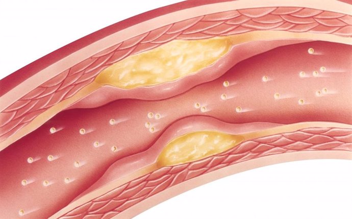 Desarrollan una herramienta que identifica qué compuestos obstruyen las arterias