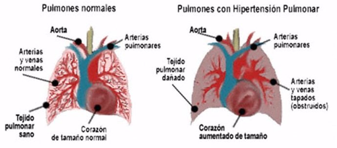 Hipertensión pulmonar arterial