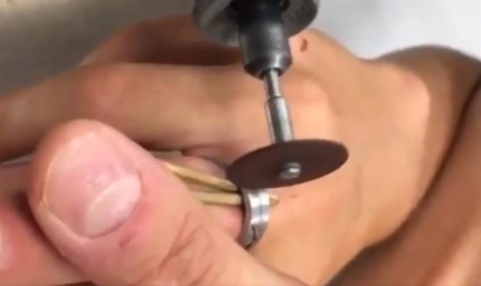 Bomberos quitan con una sierra de precisión un anillo que aprisionaba el dedo de un adolescente de 14 años en Parla