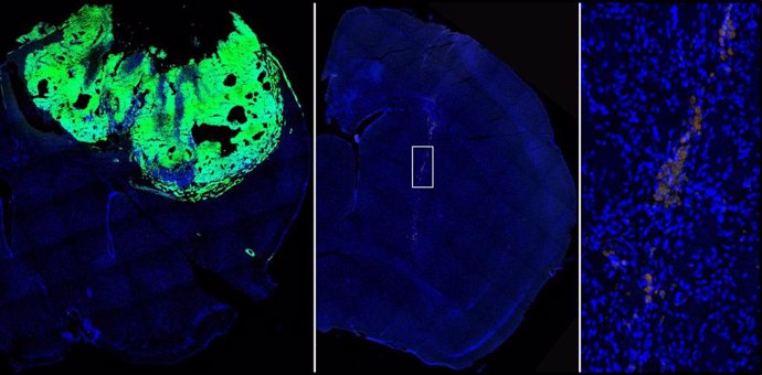 De izq a der, imagen de un cerebro de ratón con el tumor establecido normalmente; cerebro de ratón en el que se han inyectado células con la expresión de NFATc3 bloquedada, y ampliación de las pocas células tumorales localizadas en este último cerebro.