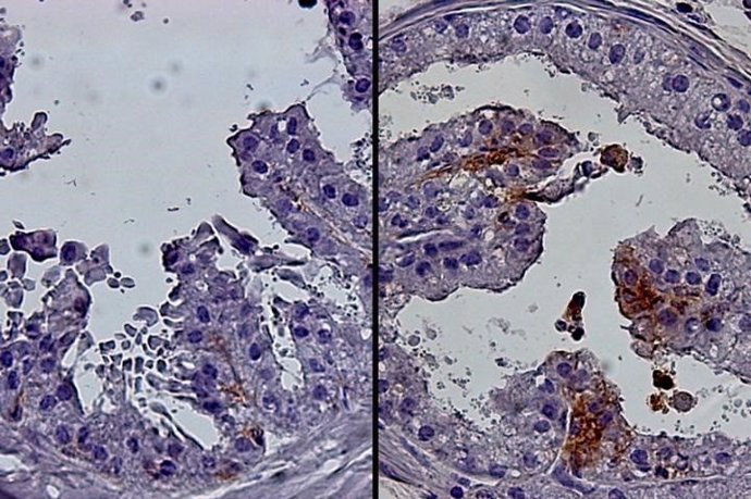 Imágenes celulares de la próstata de un ratón joven (izquierda) y de la próstata de un ratón mayor (derecha). La próstata más vieja contiene más células progenitoras luminales (marrón).