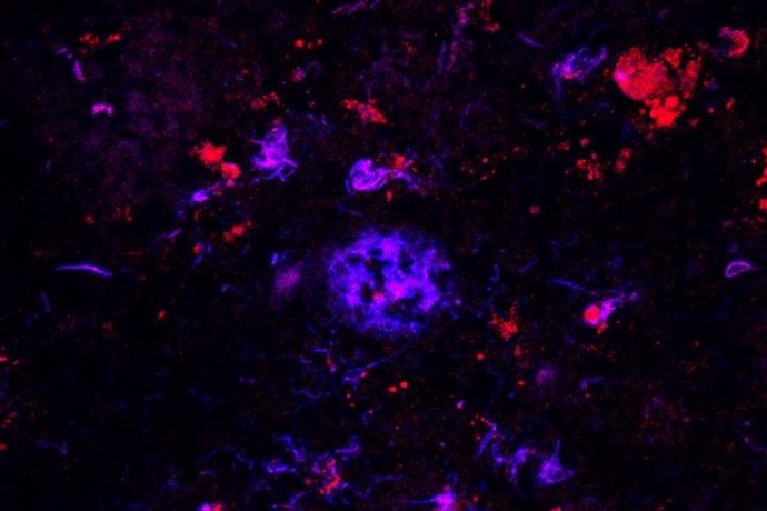 Los anticuerpos contra APOE (rojo) se unen a las placas de amiloide (azul) en el tejido cerebral de personas con enfermedad de Alzheimer.