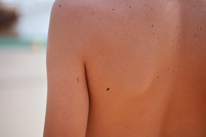 La presencia y la cantidad de lunares en el cuerpo está influenciado por la gené