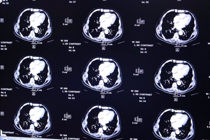 Radiografías, electroencefalogramas, actividad del cerebro, tumor, tumores cerebrales, resonancia magnética, escaner, escaneres cerebrales