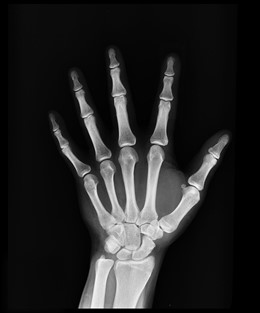 Radiografía de mano