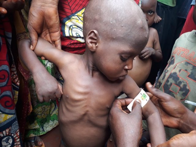 Un niño con desnutricíon en República Democrática del Congo
