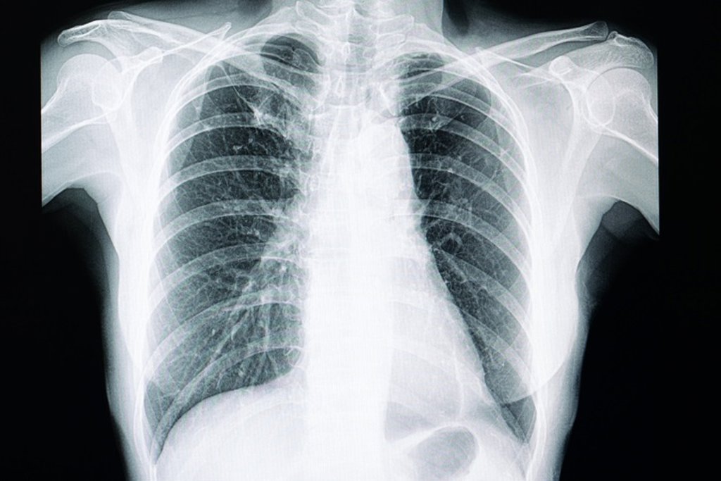 Resultado de imagen para fibrosis pulmonar
