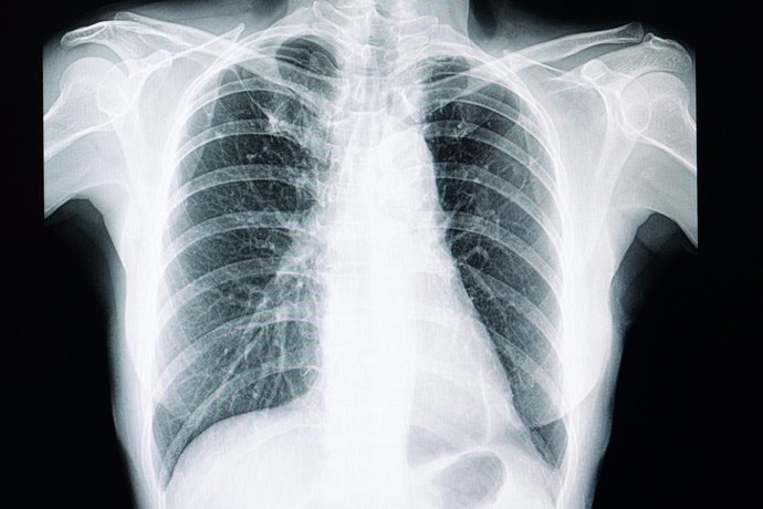 Pulmones, radiografía de tórax