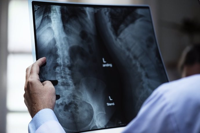 Radiografía de columna vertebral, escoliosis, huesos