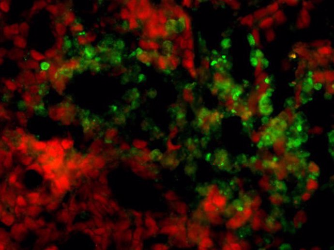 La administración del compuesto 10580 provoca que los GIC humanos (rojos) trasplantados en ratones sufrieran apoptosis, un tipo de muerte celular (verde).
