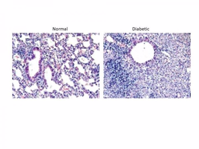 Secciones pulmonares a partir de los 21 días después de la infección con MERS-CoV en ratones normales (izquierda) y ratones diabéticos (derecha).