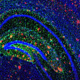 Las placas de amiloide (en rojo) salpican el cerebro de un modelo de ratón con enfermedad de Alzheimer. Los científicos han encontrado que un antidepresivo puede reducir la producción del componente primario en estas placas.