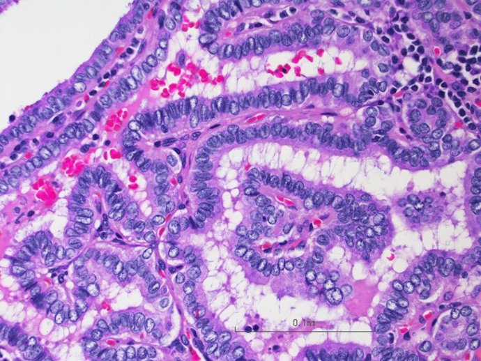 Imagen al microscopio de células de cáncer de tiroides, específicamente carcinoma papilar de tiroides, o PTC.