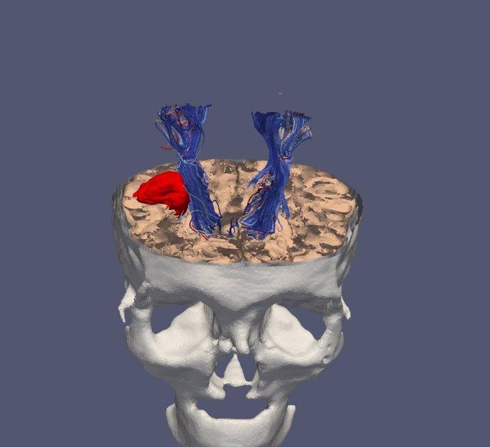 Imagen 3D de un tumor cerebral para facilitar la operación a los cirujanos