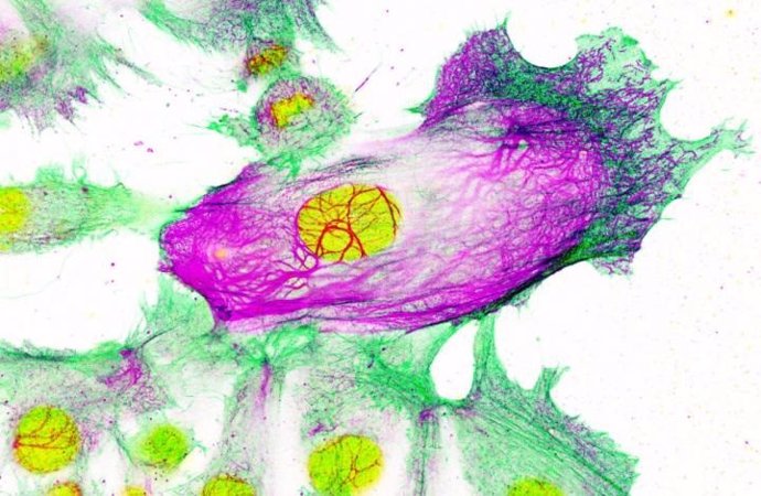 Células de cáncer de mama resistentes a los medicamentos rodeadas de células no resistentes. El núcleo de la célula (en amarillo) mientras la queratina-80 se muestra en color púrpura