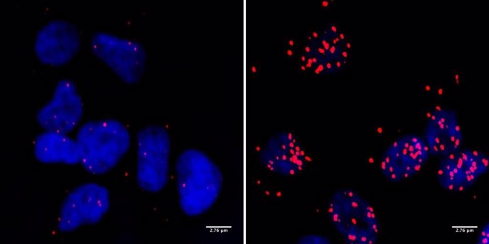 Células de un neuroblastoma: los puntos rojos marcan los sitios donde la proteína BRCA1 ocurre en contacto cercano con la ARN polimerasa II. Este es solo el caso si la proteína MYCN también está presente (derecha).