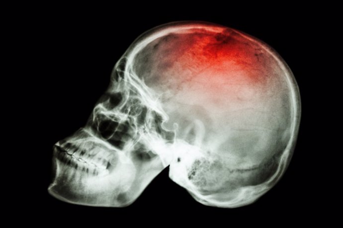 X-ray skull lateral with "Stroke"