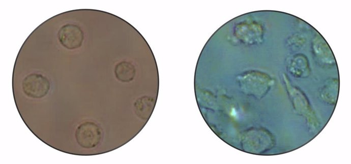 Imagen microscópica de células leucémicas tipo B (izquierda) que se convierten en otro tipo de célula, macrófagos (derecha).