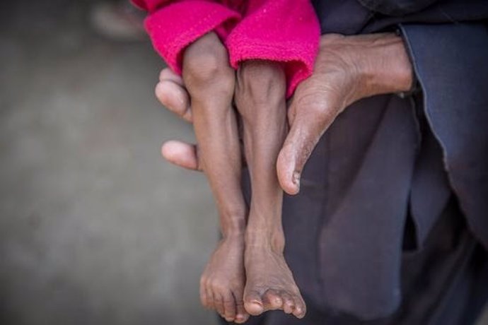 Un niño con desnutrición
