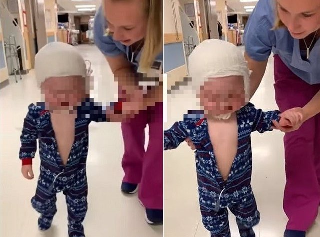 Dos días después de una operación de cráneo, este niño de dos años sorprende a sus padres dando sus primeros pasos