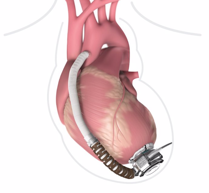 Suministrar bloqueadores neurohormonales a pacientes con válvula cardíaca mejora