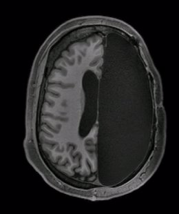 Imagen fr resonancia magnéticaque muestra el cerebro de un adulto al que se le extirpó un hemisferio completo durante la infancia debido a la epilepsia. Hemisferectomía.