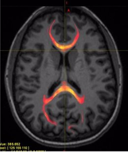Imagen de RMN de un paciente con lesión cerebral traumática leve que muestra tractografía de fibra callosa del cuerpo